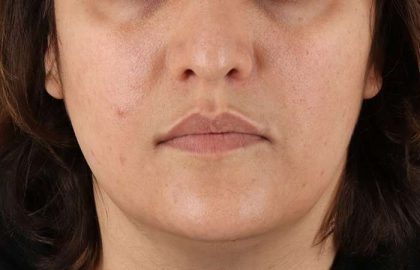 Neck Lift Before & After Patient #2560