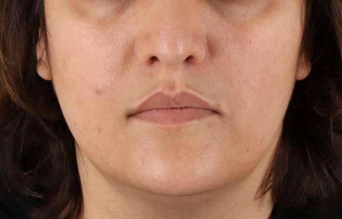 Neck Lift Before & After Patient #2560