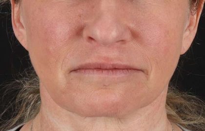 Neck Lift Before & After Patient #2571