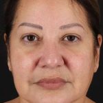 Neck Lift Before & After Patient #2593