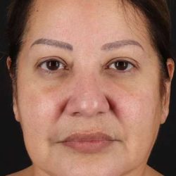 Neck Lift Before & After Patient #2593