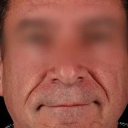 Neck Lift Before & After Patient #2604