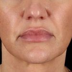 Neck Lift Before & After Patient #2626