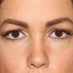 Browlift Before & After Patient #1384