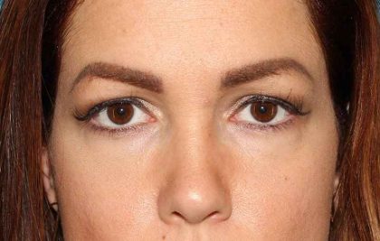 Browlift Before & After Patient #1384