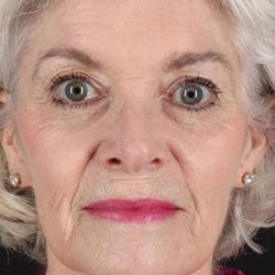 Neck Lift Before & After Patient #2637