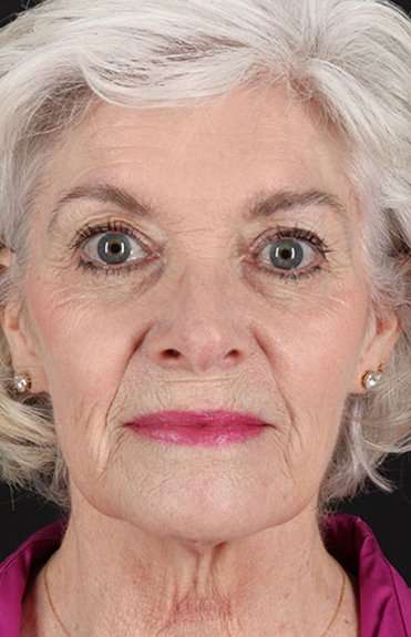 Neck Lift Before & After Patient #2637