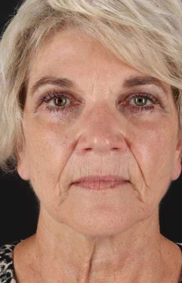 Neck Lift Before & After Patient #2648