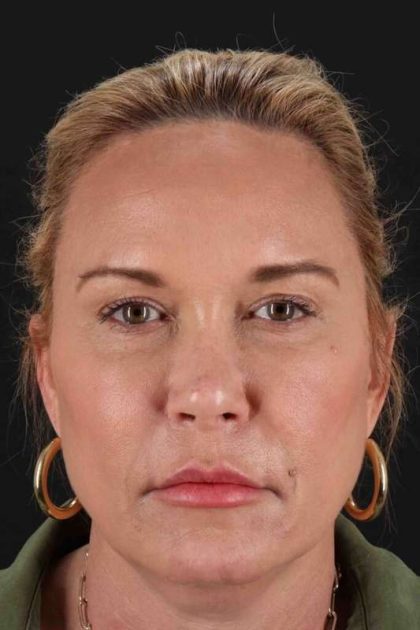 Neck Lift Before & After Patient #2659