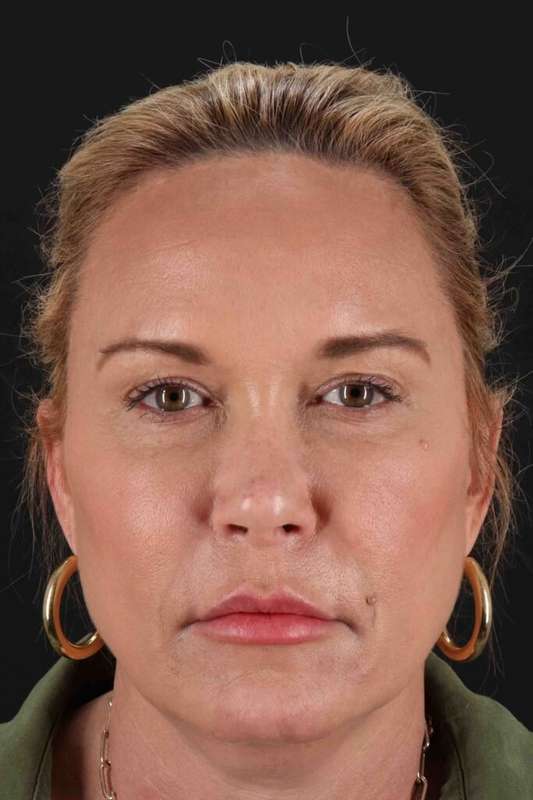 Neck Lift Before & After Patient #2659