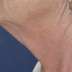 Neck Lift Before & After Patient #2670