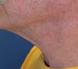 Neck Lift Before & After Patient #2673