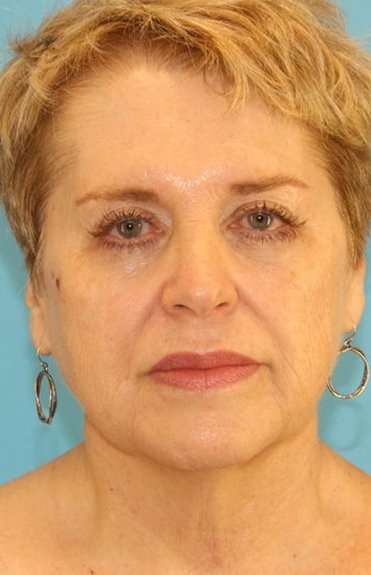 Neck Lift Before & After Patient #2680