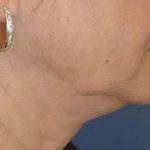 Neck Lift Before & After Patient #2683