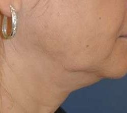 Neck Lift Before & After Patient #2683