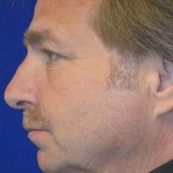 Neck Lift Before & After Patient #2686