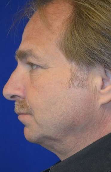 Neck Lift Before & After Patient #2686
