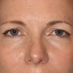 Browlift Before & After Patient #1391