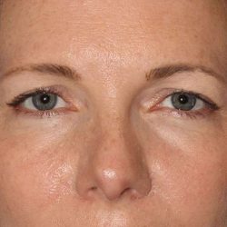 Browlift Before & After Patient #1391