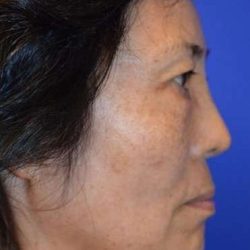 Neck Lift Before & After Patient #2689