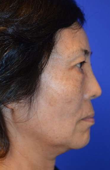 Neck Lift Before & After Patient #2689