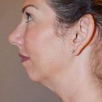 Neck Lift Before & After Patient #2692