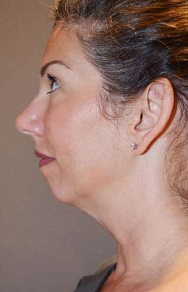 Neck Lift Before & After Patient #2692