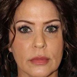 Neck Lift Before & After Patient #2699