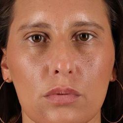 Neck Liposuction Before & After Patient #2719