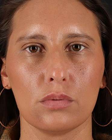Neck Liposuction Before & After Patient #2719