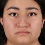Neck Liposuction Before & After Patient #2730