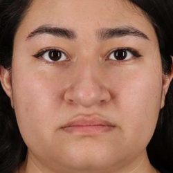 Neck Liposuction Before & After Patient #2730