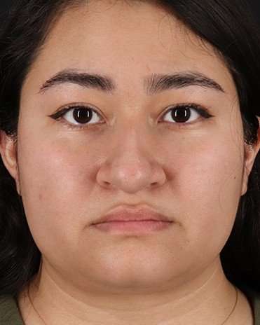 Neck Liposuction Before & After Patient #2730