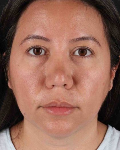 Neck Liposuction Before & After Patient #2741