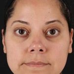 Neck Liposuction Before & After Patient #2752