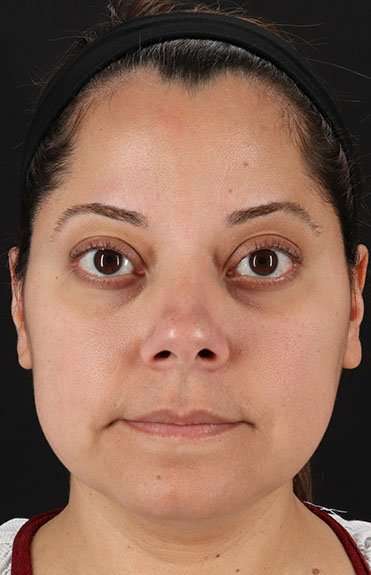 Neck Liposuction Before & After Patient #2752
