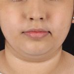 Neck Liposuction Before & After Patient #2774