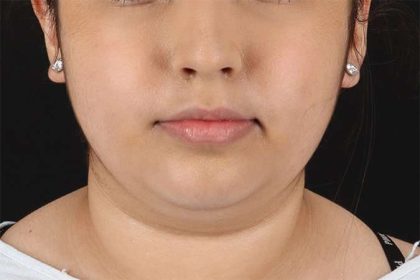 Neck Liposuction Before & After Patient #2774