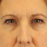 Browlift Before & After Patient #1402