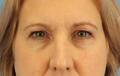 Browlift Before & After Patient #1402