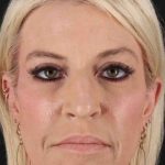Rhinoplasty Before & After Patient #2796