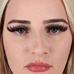 Rhinoplasty Before & After Patient #2807
