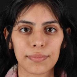 Rhinoplasty Before & After Patient #2818