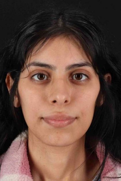 Rhinoplasty Before & After Patient #2818