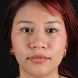 Rhinoplasty Before & After Patient #2829