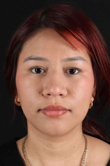 Rhinoplasty Before & After Patient #2829