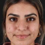 Rhinoplasty Before & After Patient #2862