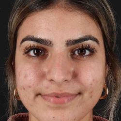 Rhinoplasty Before & After Patient #2862
