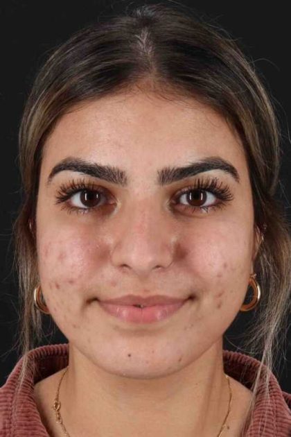 Rhinoplasty Before & After Patient #2862