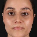 Rhinoplasty Before & After Patient #2873